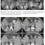 Sách Imaging of the Liver and Intra-hepatic Biliary Tract Volume 2