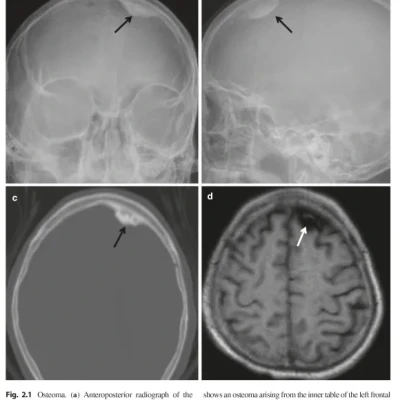 Sách Oncologic Imaging Bone Tumors